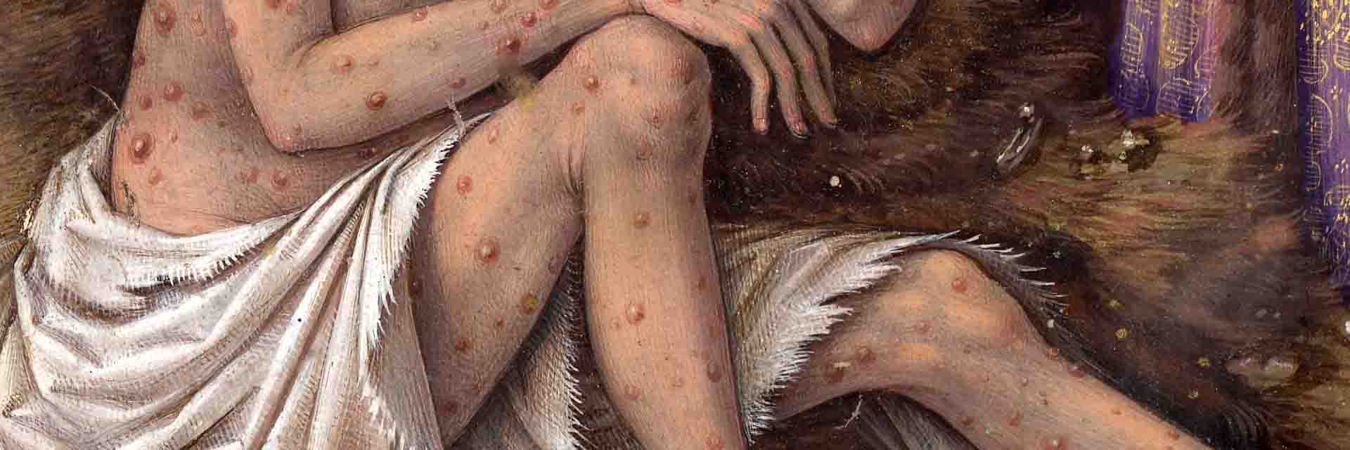 Infectitious Disease Histories